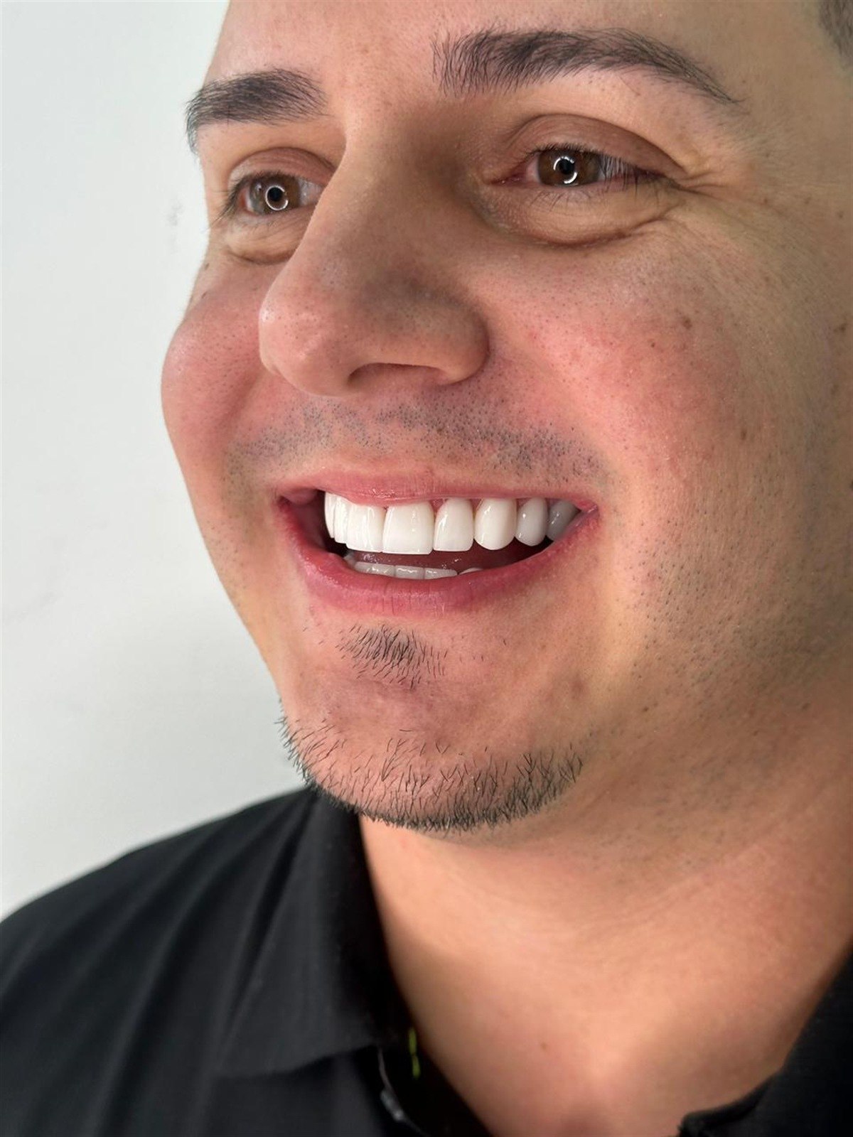 Resultado de diseño de sonrisa en cerámica realizado en Medellín