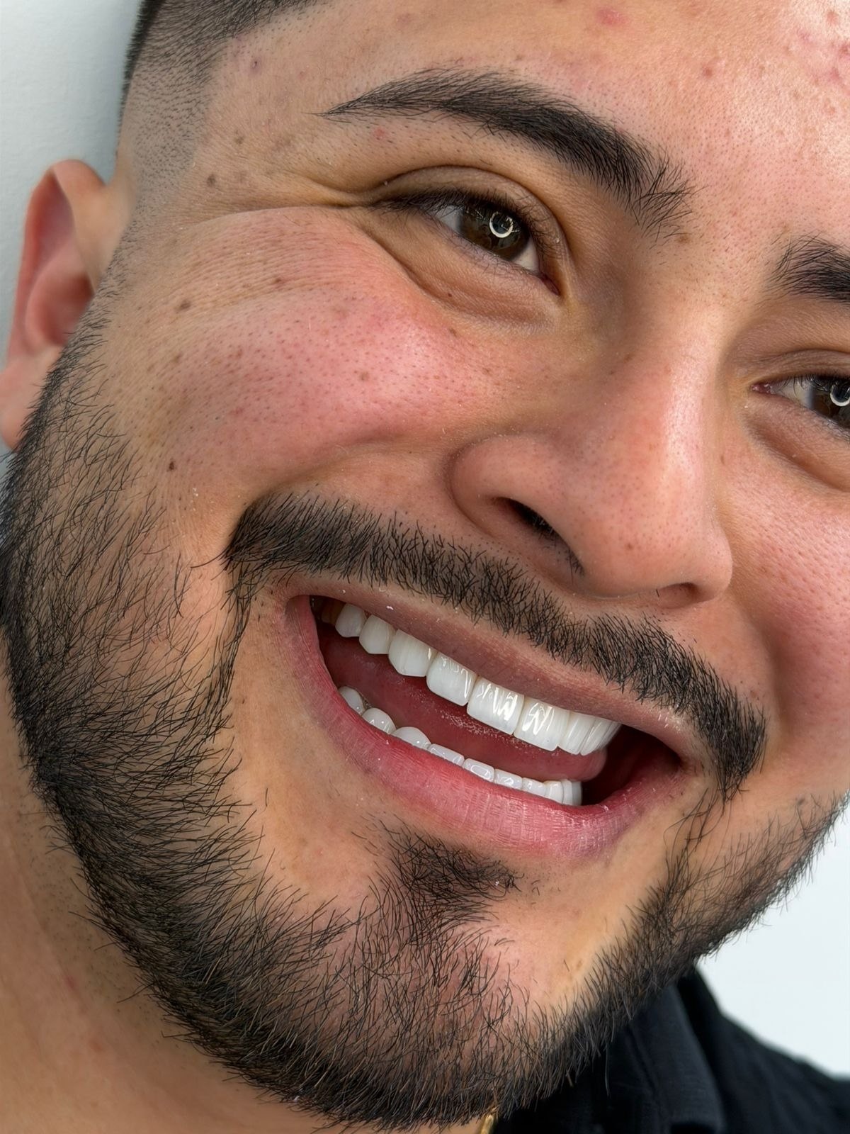 Resultado natural de diseño de sonrisa en resina