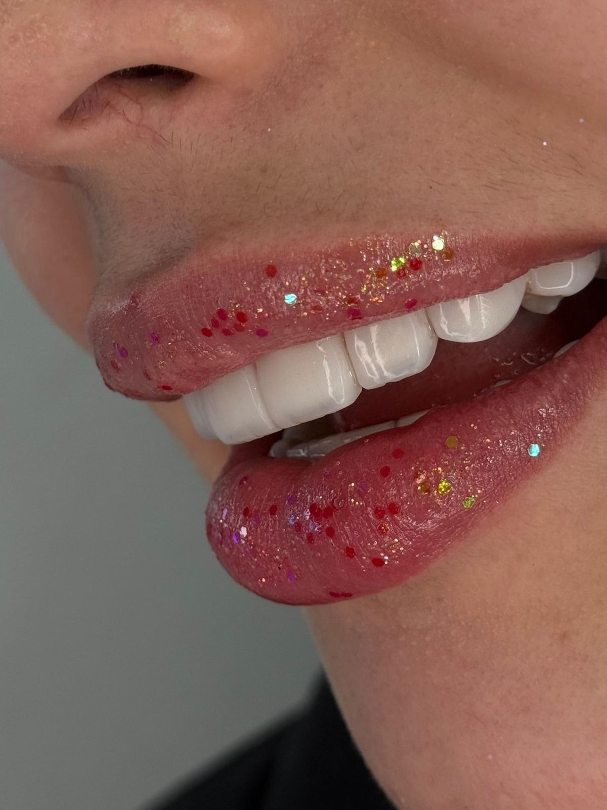 Resultado estético de microdiseño dental en resina